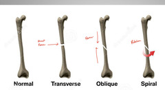 <p>transverse, oblique, spiral</p>