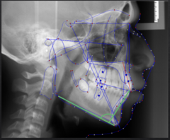 <p>What dental measurement:</p><p>- Mandibular Plane vs Long Axis of L1</p><p>- AP relationship between the body of the mandible and the lower incisors</p><p>- Tells you about the angulation of the lower incisors</p>
