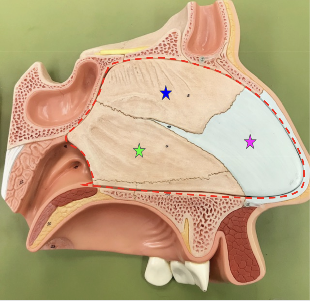 <p>Red area: Nasal septum - divides the nasal cavity into left &amp; right</p><p>Broken into 3 parts: pink, blue, &amp; green stars</p><p>- Anterior portion of nasal septum:</p><ul><li><p>Pink: Septal cartilage</p></li></ul><p>Posterior portion of nasal septum: (bony portion)</p><ul><li><p>Blue: Perpendicular plate of ethmoid bone</p></li><li><p>Green: Vomer</p></li></ul><p></p>