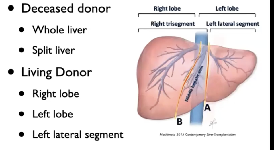 <ul><li><p>Deceased donor </p><ul><li><p>maybe whole liver </p></li><li><p>split liver transplant may occur - not often </p><ul><li><p>left lateral segment of liver usually used for pediatric recipient </p></li><li><p>right lobe graft used for an adult recipient </p></li></ul></li></ul></li><li><p>Living donor </p><ul><li><p>most common at uHn - right lobe adult to adule can be used </p></li><li><p>left lateral segment can be procured for a pediatric liver transplant recipient </p></li><li><p>rarely - left lobe transplant peformed </p></li></ul></li></ul><p></p>