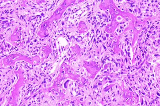 <p>Lésion métaphyse tibia garçon de 15 ans</p><p>Diagnostic</p><p>Définition</p><p>Age</p><p>Topographie</p><p>Anatomie</p><p>Sous types </p><p>Histologie</p><p>Moléculaire</p>