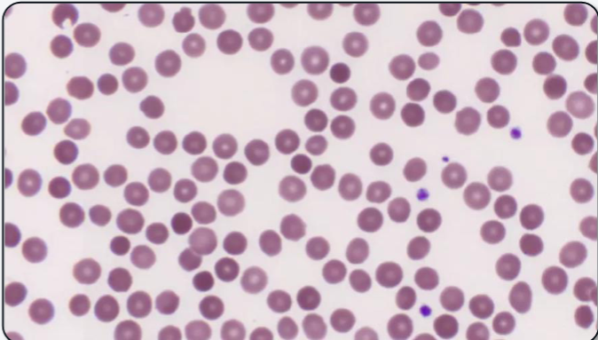 <p>What abnormal RBC shape is shown? What anemias (2) is it most commonly associated with?</p>