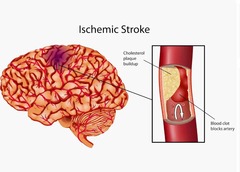 <p>Ischemic Stroke and Hemorrhagic Stroke.</p>