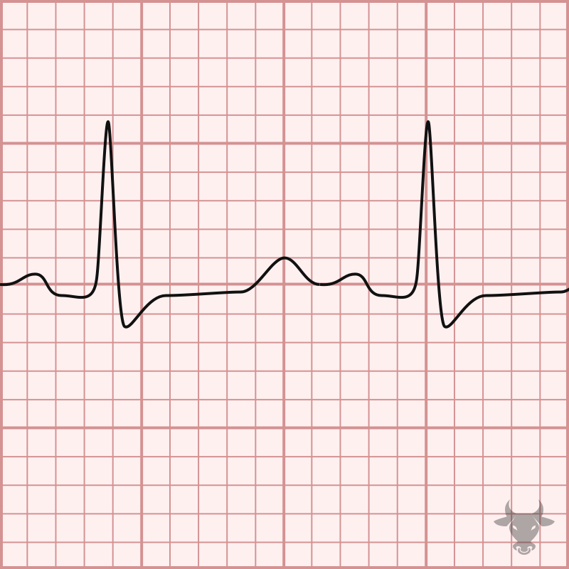 <p>Identify the electrolyte imbalance based on the ECG: </p><ul><li><p>Prolonged ST segment</p></li><li><p>Prolonged QT interval</p></li></ul><p></p>