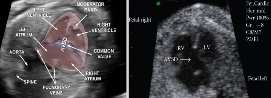 <ul><li><p><span style="background-color: transparent;">AKA endocardial cushion defect</span></p></li><li><p><span style="background-color: transparent;">Fetus has both ASD and VSD</span></p></li><li><p><span style="background-color: transparent;">US findings: large defect along cardiac midline</span></p></li></ul><p></p>