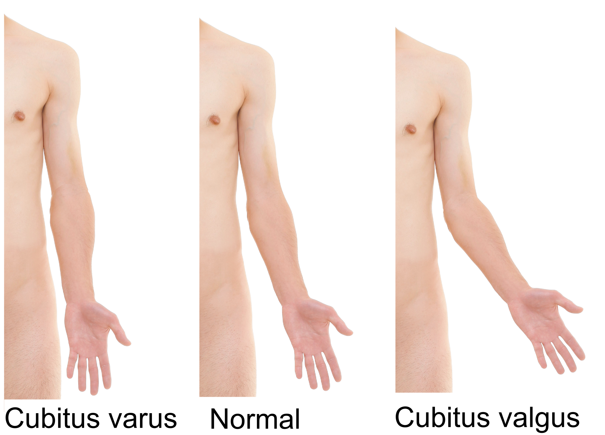<p><span>excessive carrying angle (forearm is lateral)</span></p>