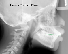 <p>which reference plane:</p><p>- Point 1: Molar occlusal contact</p><p>- Point 2: Bisection of the overbite</p>