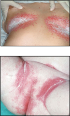 <p>presentation of candidiasis of the skin</p>