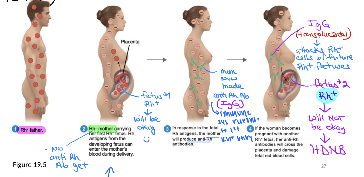 <ul><li><p>Rh- female (but no anti-Rh ABs yet) → Rh+ fetus (1st pregnancy) → mom produce anti-Rh Ab’s AFTER birth (mixing of maternal &amp; fetal circulation)</p></li><li><p>mom’s anti-Rh Ab’s will <mark data-color="yellow" style="background-color: yellow; color: inherit;">attack 2nd Rh+ fetus (2nd pregnancy</mark>) → damageing fetal RBCs → HDNB</p></li></ul><p><u>outcomes (newborn):</u></p><ul><li><p>50% normal RBC count</p></li><li><p>25% moderate dz &amp; require immediate tx</p></li><li><p>25% severe dz → stillborn/severe complications</p></li></ul><p></p>