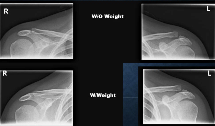 <p>AP Acromioclavicular </p>