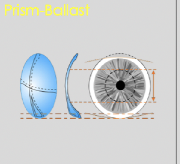 <ul><li><p>1 to 1.5 D Base-down prism (thicker at the bottom)</p></li></ul><p></p><ul><li><p>stabilised by prism-induced CL thickness differences </p></li></ul><p></p><ul><li><p>however decrease in CL O2 transmissibility </p></li></ul><p></p><ul><li><p>discomfort with CL-lid interaction </p></li></ul><p></p>