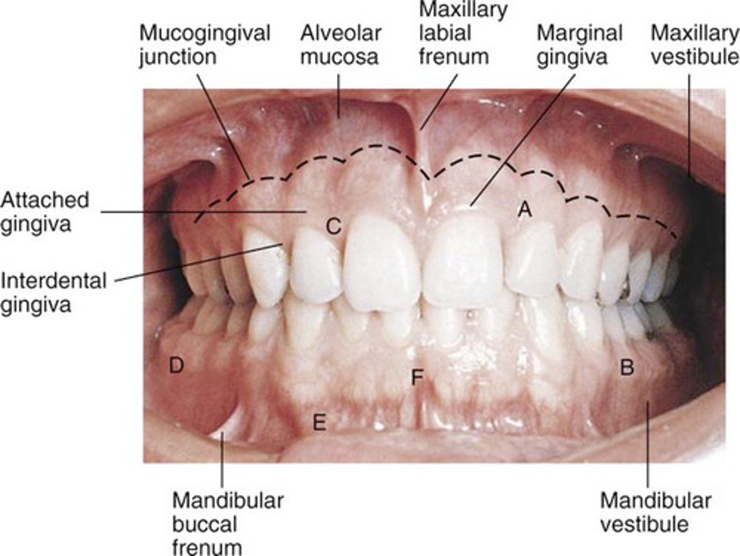 <p>gingiva bound to underlying alveolar bone</p>