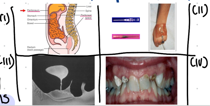 <p><strong>i. <mark data-color="#ffe4fd" style="background-color: rgb(255, 228, 253); color: inherit;">Bacteroides</mark> in abdominal infections</strong> eg peritonitis.</p><p><strong>ii.<em> <mark data-color="purple" style="background-color: purple; color: inherit;">Staphylococcus epidermidis</mark></em></strong> in intravenous catheter infections.</p><p>iii.<strong><em> Escherichia coli</em></strong> in UTIs</p><p>iv.<strong> Dental plaques, caries and periodontal disease.</strong></p>