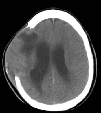 <ol><li><p><span style="color: rgb(244, 95, 95);"><strong>epidural </strong>hematoma</span></p></li></ol><ul><li><p><span style="color: rgb(244, 95, 95);">causes rapid <strong>neuro decline</strong></span></p></li></ul><ol start="2"><li><p><span style="color: rgb(175, 102, 227);"><strong>subdural </strong>hematoma</span></p></li></ol><ul><li><p><span style="color: rgb(175, 102, 227);">bleed after head injury</span></p><ul><li><p><span style="color: rgb(175, 102, 227);"><strong>causes <span data-name="arrow_up" data-type="emoji">⬆</span>ICP</strong>→ HA, slurred speech</span></p></li></ul></li></ul><ol start="3"><li><p><span style="color: rgb(13, 145, 141);"><strong>cerebral edema</strong></span></p></li></ol><ul><li><p><span data-name="arrow_down" data-type="emoji">⬇</span>blood flow to brain</p></li><li><p><span data-name="arrow_up" data-type="emoji">⬆</span>ICP</p></li></ul><ol start="4"><li><p><span style="color: rgb(177, 115, 25);"><strong>brain herniation</strong></span></p></li></ol><ul><li><p><span style="color: rgb(177, 115, 25);">brain tissue <strong>shifts</strong></span><strong> </strong>d/t high ICP (life threatening!!)</p></li><li><p>Cushings</p></li><li><p>loss of blinking &amp; gag reflex</p></li><li><p>pupils dont react to light</p></li></ul><p></p>