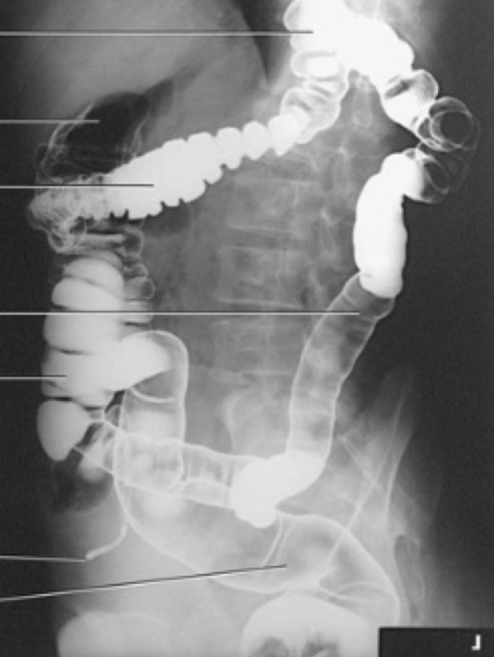 <p>Splenic (left colic) flexure</p>