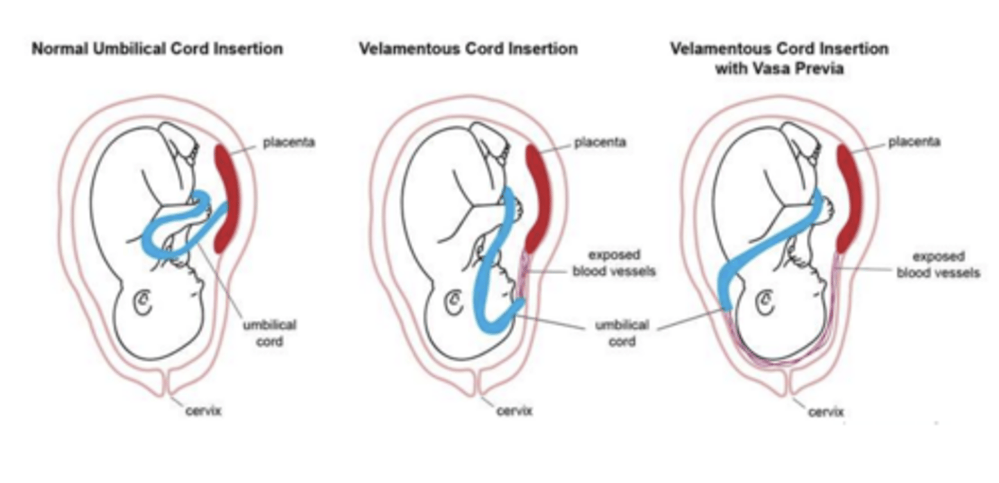 <p>Presence of fetal blood vessels over the internal os below the presenting parts of the fetus</p>