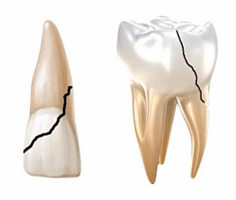 <p>-poor restorative outcome</p>