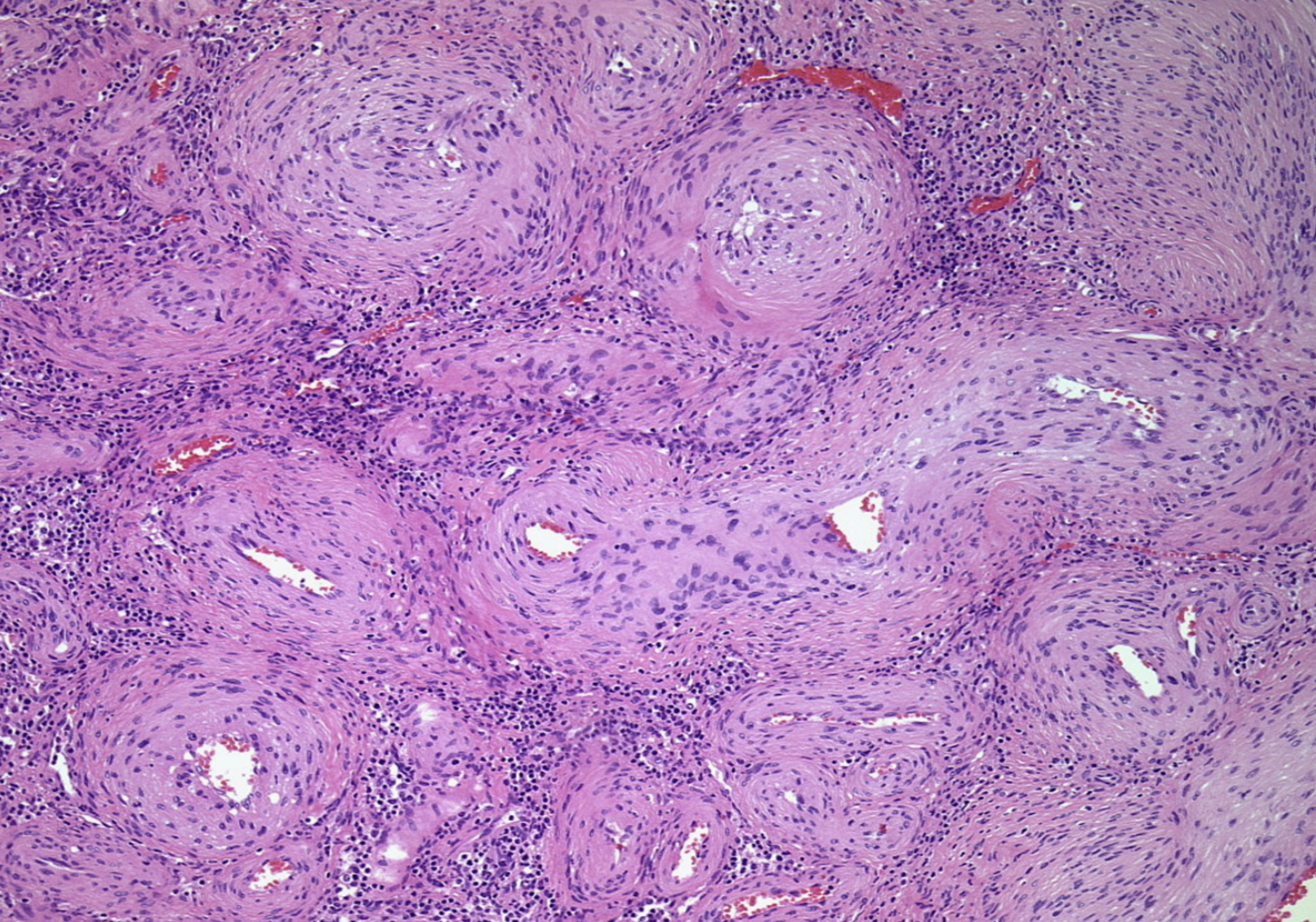 <p>tumeur dermique du pied (aspect hémangiopéricytaire au centre)</p><p>1) diagnostic</p><p>2) morphologie</p><p>3) IHC</p><p>4) moléculaire </p><p>5) localisation </p>