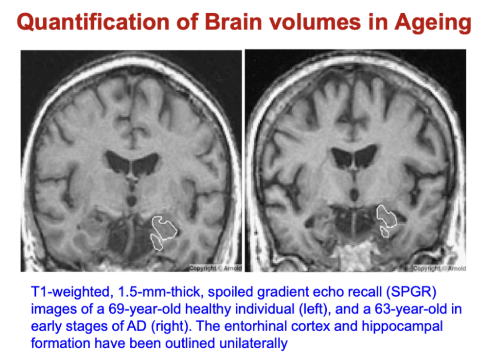 <ul><li><p>Early atrophy occurs in:</p><ul><li><p><strong>Hippocampus</strong></p></li><li><p><strong>Entorhinal cortex</strong></p></li></ul></li><li><p>Compared to healthy ageing:</p><ul><li><p>AD shows <strong>greater and earlier volume loss</strong> in these regions</p></li></ul></li><li><p>Key idea:</p><ul><li><p>These areas are critical for <strong>memory → explains early memory symptoms in AD</strong></p></li></ul></li></ul><p></p>