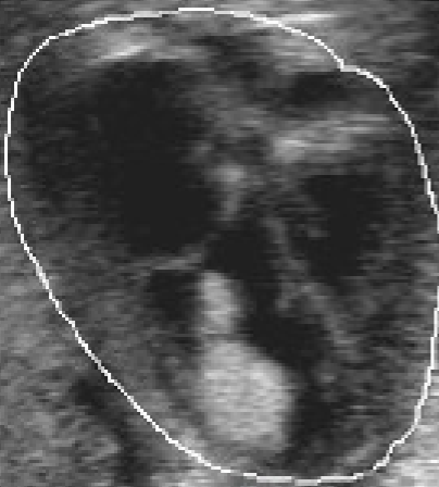 <ul><li><p>found <span style="color: rgb(167, 0, 255);">at birth</span> and <span style="color: rgb(159, 0, 255);"><1 yr</span></p></li><li><p>70-90% have <span style="color: rgb(167, 0, 255);">multiple tumors</span></p></li><li><p>associated w/ <span style="color: red;">tuberous sclerosis</span></p></li><li><p>found in <span style="color: rgb(0, 124, 255);">ventricular walls</span></p><ul><li><p><strong>more common</strong> in <span style="color: rgb(0, 109, 255);">RV</span></p></li><li><p><u>solid, echo-dense mass</u> <strong>protruding</strong> into <span style="color: rgb(0, 109, 255);">ventricular cavity</span></p></li></ul></li><li><p>mortality d/t blood flow obstruction</p></li><li><p>have been reported to <u>recede over time</u></p></li></ul><p></p>