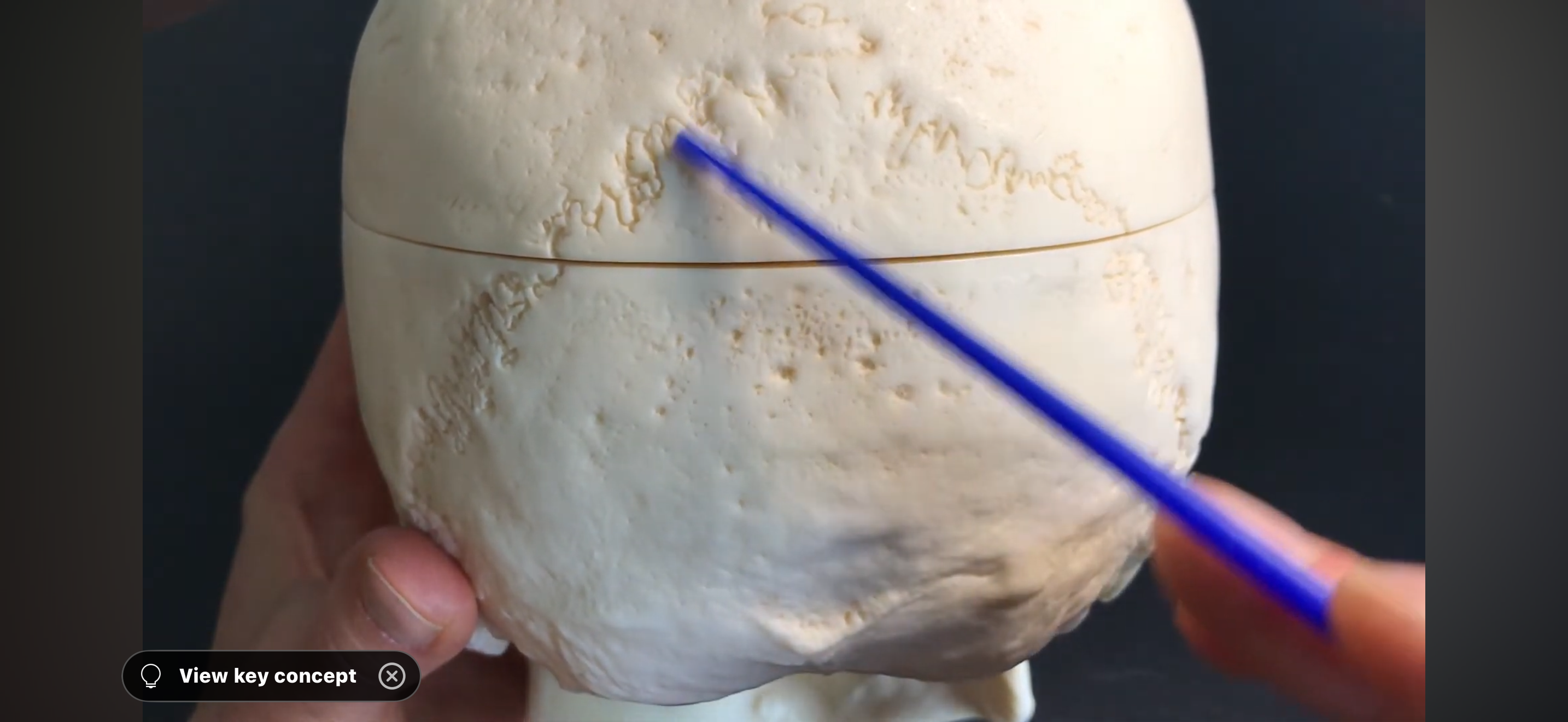 <p>What is the suture?</p>