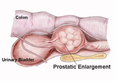 <p>What is the clinical presentation for benign prostatic hyperplasia (BPH)?</p>