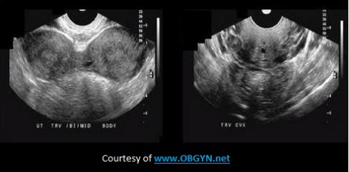 <p>What congenital abnormality is seen on the image?</p><p>A. uterine bicornis bicollis</p><p>B. uterine arcuatus</p><p>C. uterine bicornis unicollis</p><p>D. uterine subseptus</p>