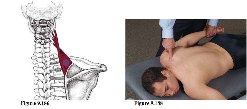 <p>IR Abd traction</p><p>Location is on the superior medial border of the scapula at the attachment of the levator scapula</p><ol><li><p>Pt prone with head looking away from point and arms at the sides</p></li><li><p>Physician sits on same side</p></li><li><p>Find spine of scapula, follow border up, point is superior and medial of the border</p></li><li><p>Physician caudad hand grabs pt wrist while other hand holds point.</p></li><li><p>Internally rotate pt shoulder and add mild to moderate traction and minimal abduction</p></li></ol><p></p>