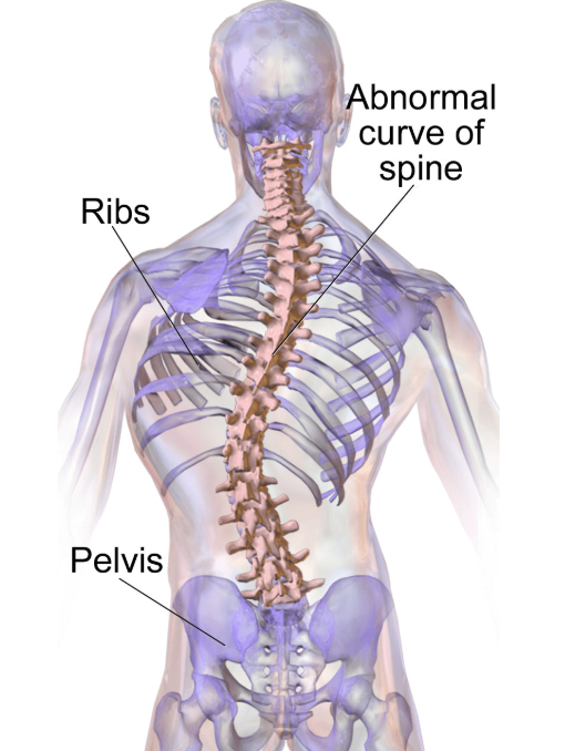 <p>abnormal lateral curvature of the spine</p>