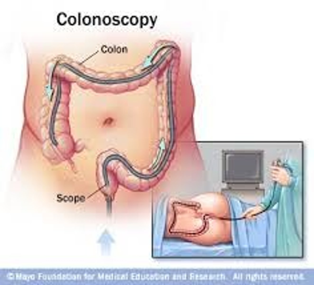<p>colonoscopy</p>