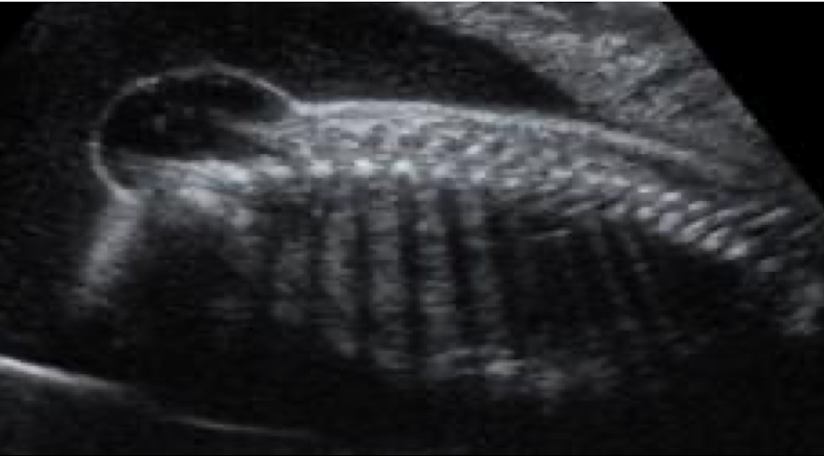 <p>spinal cord develops normally but meninges protrude from spinal opening </p><ul><li><p>skin mostly intact </p></li></ul><p></p>