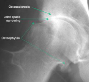 <p>Osteoarthritis</p>