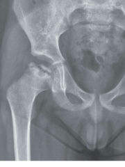 <p>Idiopathic avascular necrosis (causes bone to shrink) of the proximal femoral epiphysis</p><p>*blood supply to femoral head is lost*</p><p>Disruption -> Revascularization -> Resorption -> Collapse</p>