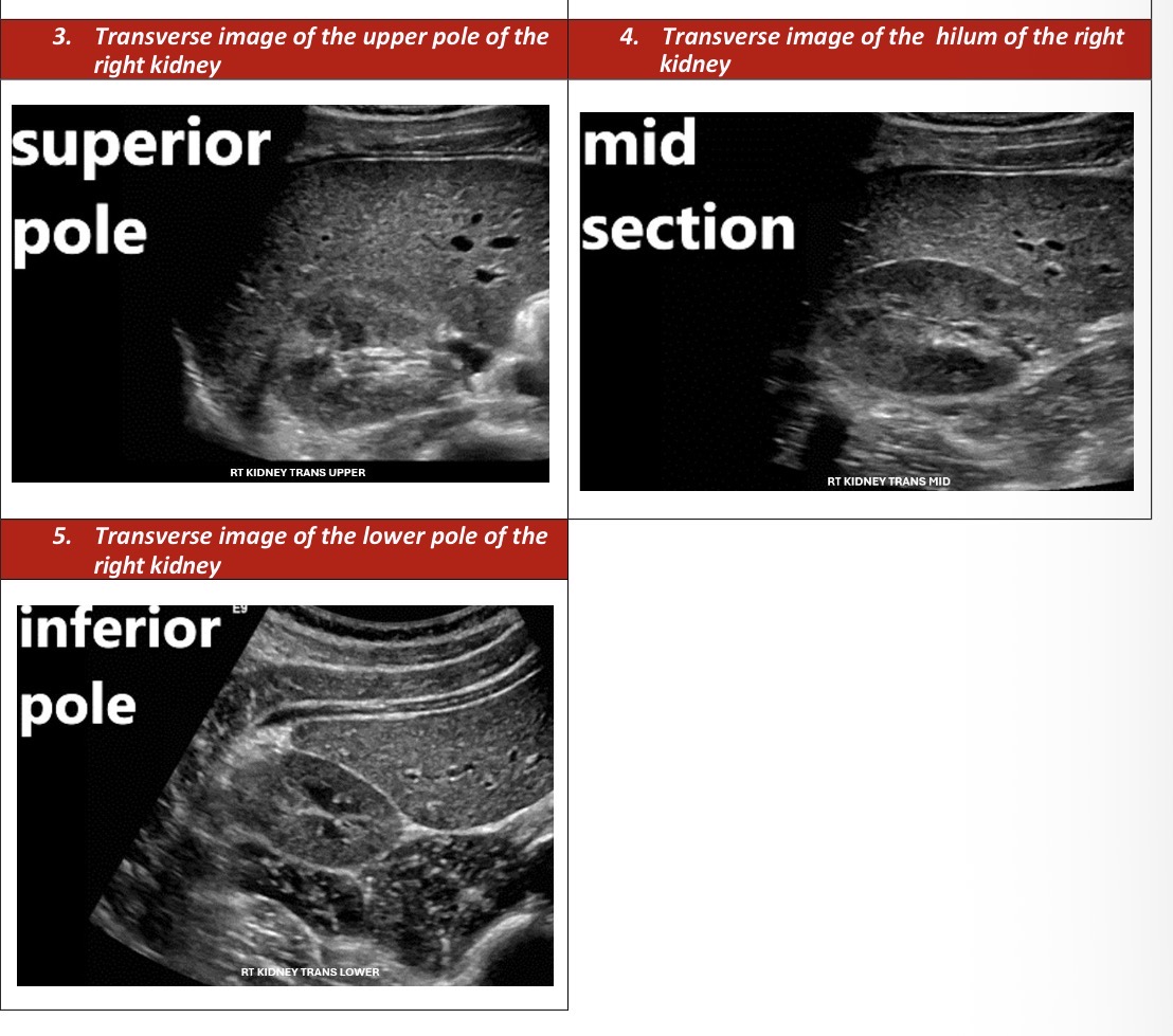 <p>Right Kidney Transverse Survey </p>