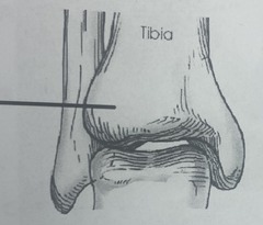 <p>Expanded process at the distal anterior & lateral tibia, Articulates with the superolateral talus, Partially overlaps the fibula anteriorly, (distal portion of tibia)</p>