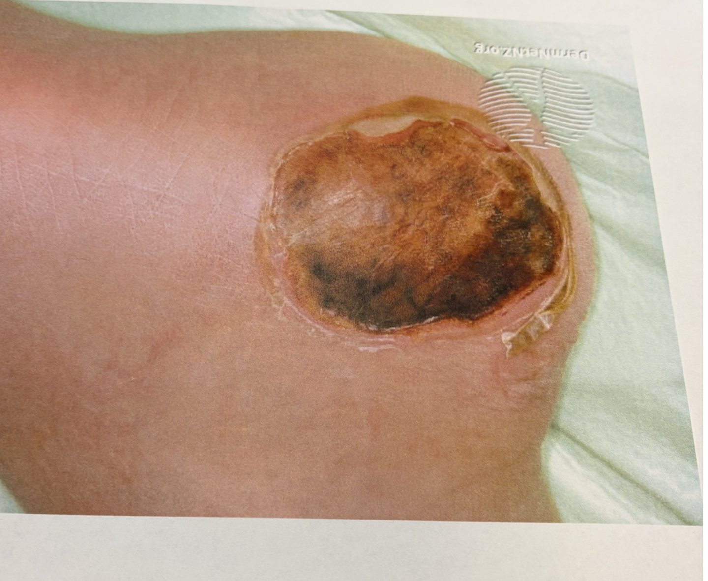 <p>how do you care for this wound?</p>