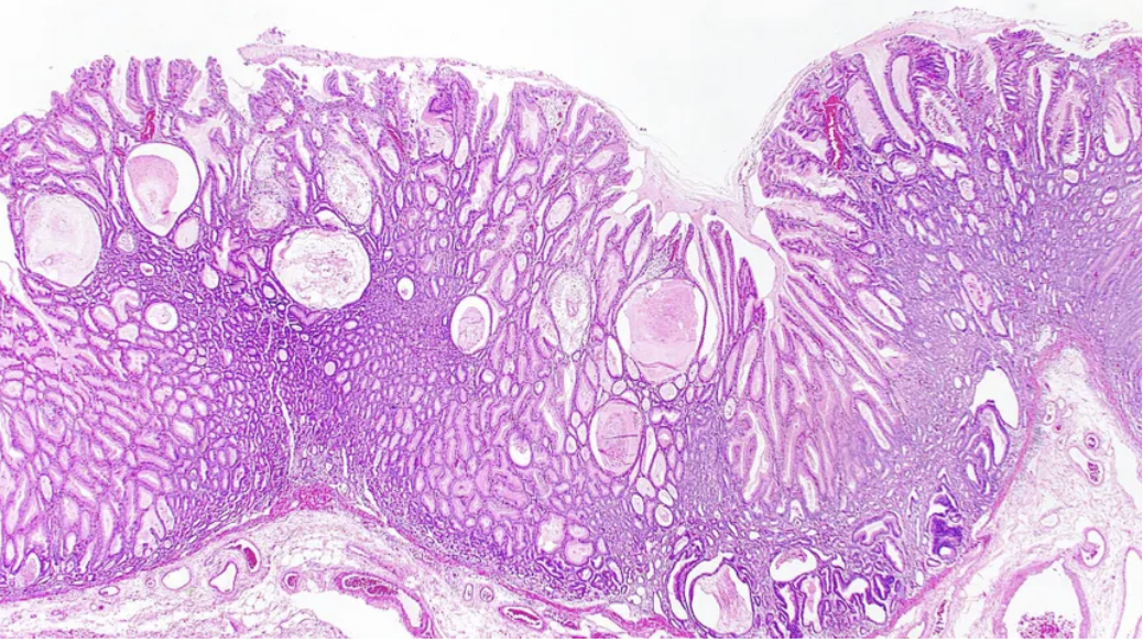 <p>Patient avec oedèmes</p><p>1) diagnostic</p><p>2) clinique et physiopatho</p><p>3) histo</p><p>4) particularité en pédiatrie </p>