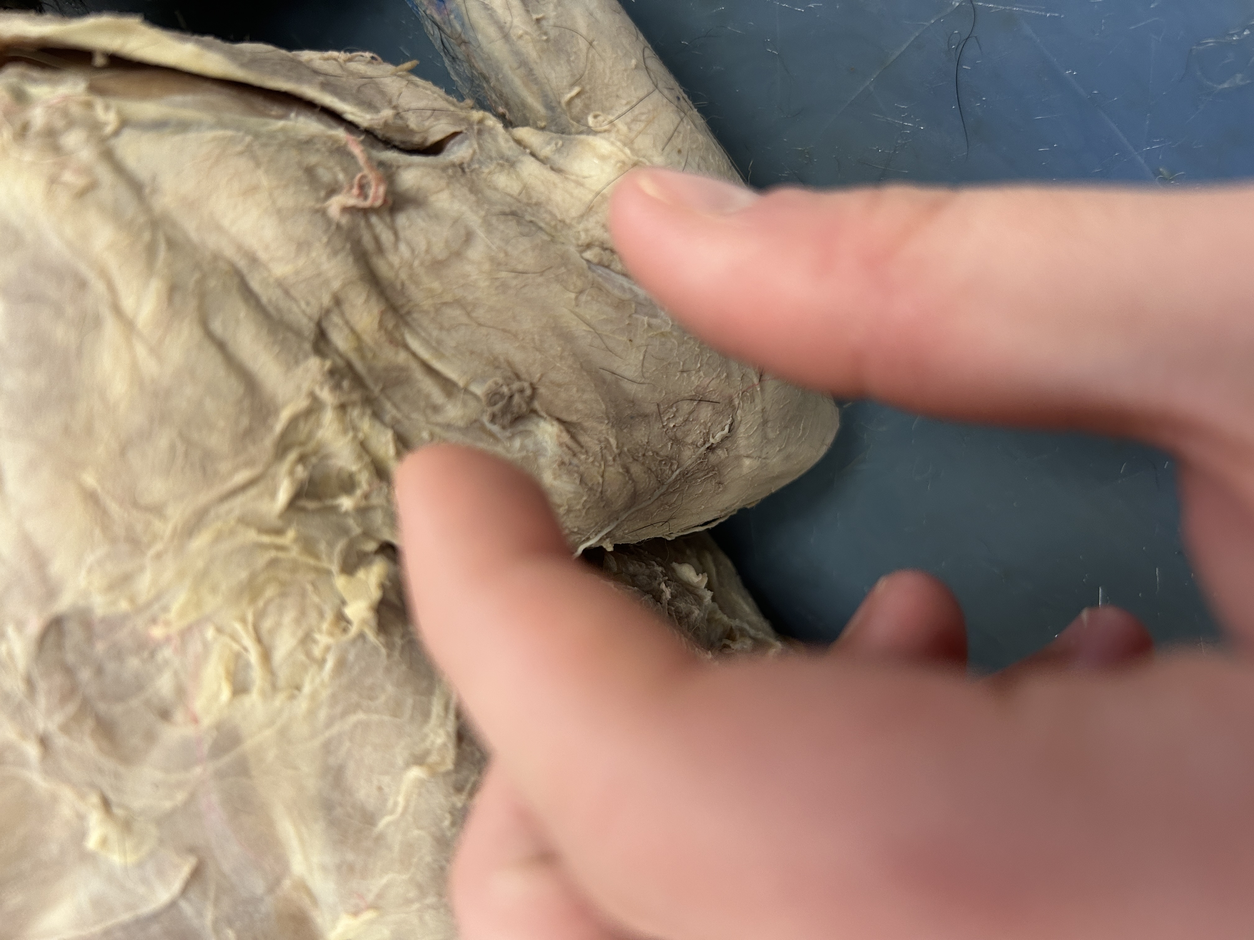 <p>Lateral Tricep Brachii head </p>