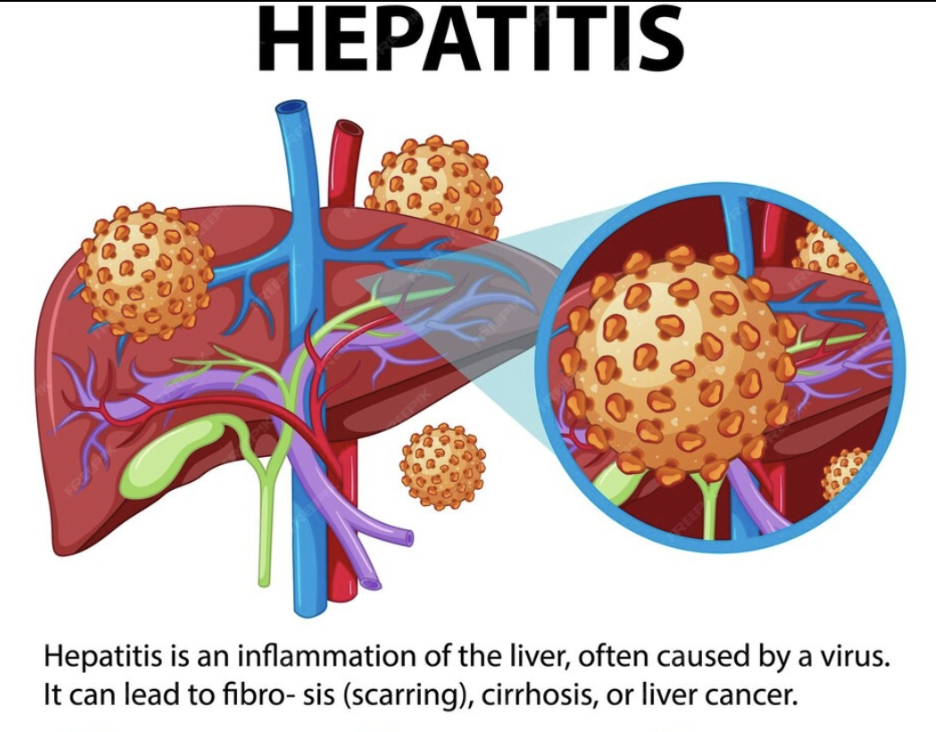 <p>Right upper quadrant pain, jaundice/yellow skin, fatigue, nausea, decreased appetite</p>