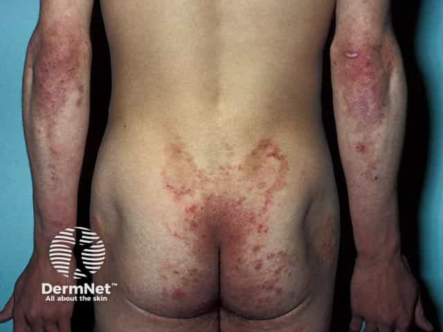 <p>most common extraintestinal manifestation of celiacs?</p>