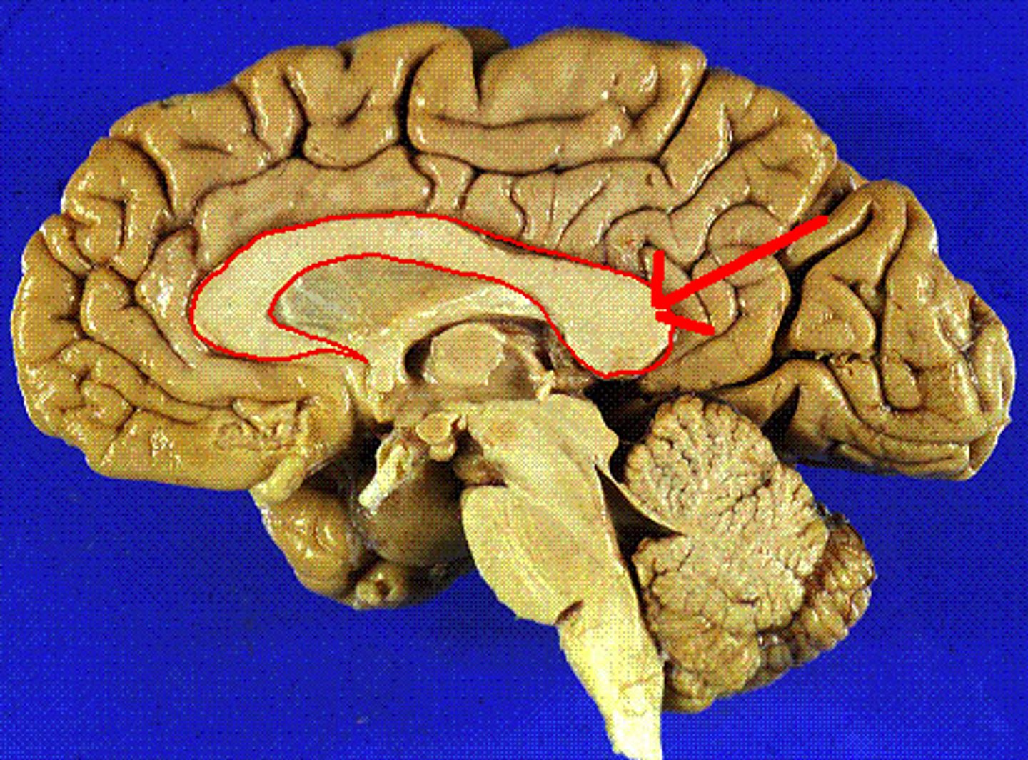<p>Connects hemispheres</p>