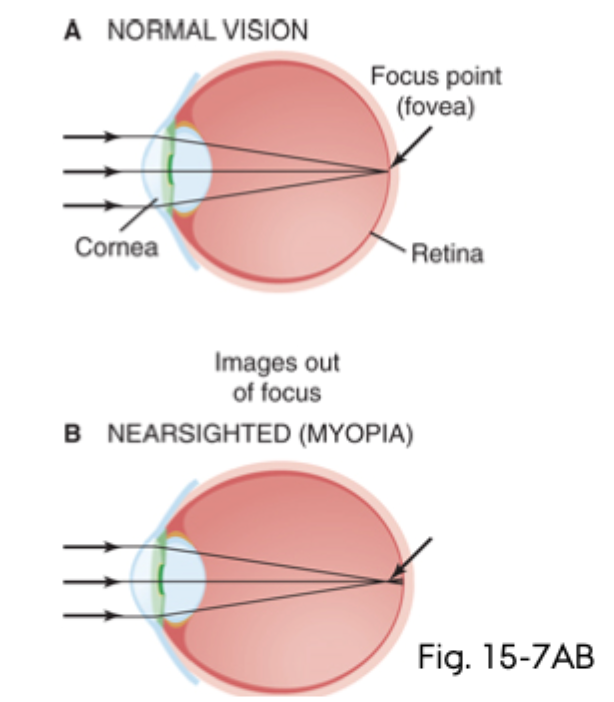 <p><strong>Fjerne objekter</strong> bliver uskarpe, mens <strong>nære objekter</strong> kan fokuseres på retina uden eller med mindre behov for akkommodation.</p>