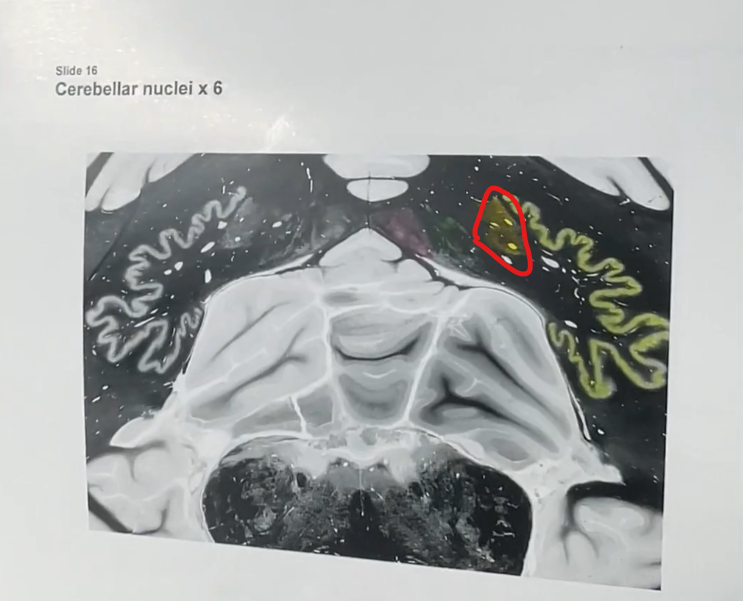 <p>working our way medially, this is the “eat” part of “dont eat greasy foods”. </p><p>Circled in red is the <strong>emboliform nucleus</strong> of the cerebellum. </p>