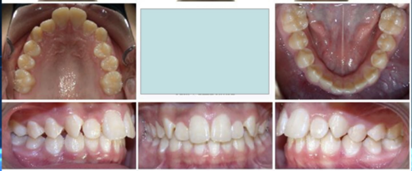<p>What are the two treatment options for correcting this patients class II sequence on his right?</p>