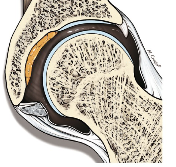 <p>What condition of the ligamentum teres is shown</p>