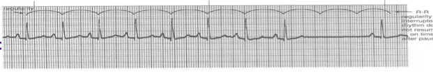 <p>Identify:<br>a. sinus block<br>b. sinus arrest<br>c. 1st degree heart block<br>d. sinus arrhythmia </p>