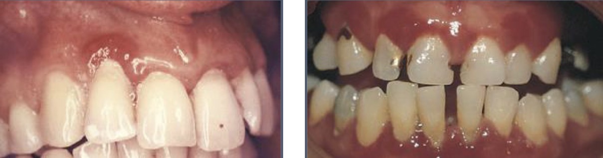 <p>Inflammation extends from gingival margin to mucogingival line (goes apically) in 1 or more teeth </p><p>Affects entire gum, alveolar mucosa and inserted gum are inflamed, mucogingival line erased </p>