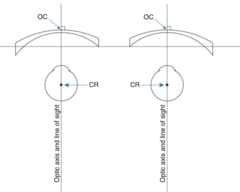<p>If the wearer's PD is less than the frame PD, how should the face forming be shaped?</p>
