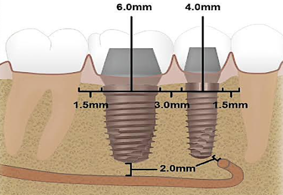 <p>Minimum required distance between implant and <span>Adjacent natural tooth</span></p>