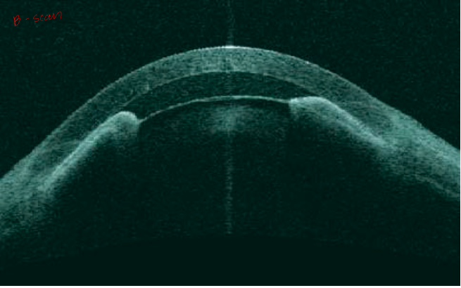 <p>normal curvature of the iris</p><p>angle closed the whole way (periphery and central) </p><p>no iris bombe </p>